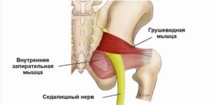 Синдром грушевидной мышцы?