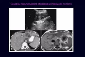 Образование в брюшной полости