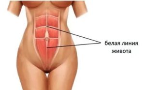 Грыжа белой линии живота при беременности