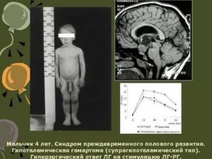 Адреногенитальный синдром у мальчика