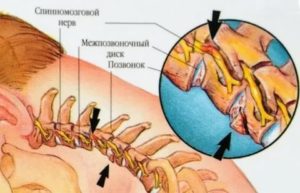 Шейный остеохондроз, вертеброгенная цервикалгия