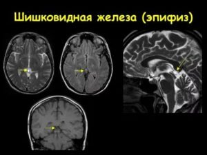 Кистозная трансформация головного мозга