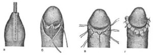 Фимоз и надрыв крайне плоти