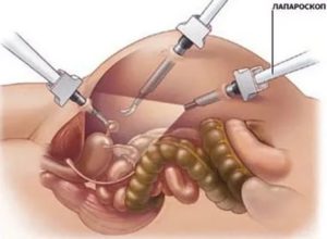Боль под рёбрами после лапароскопии