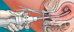 Боли после вакуумной чистке