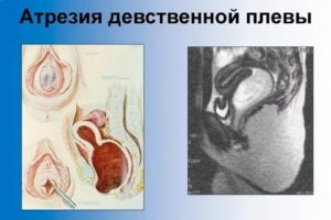 Надрыв девственной плевы