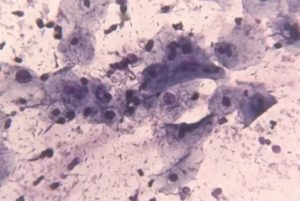 Цитологическое исследование. Паракератоз плоского эпителия