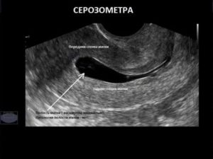 Серозометра при беременности