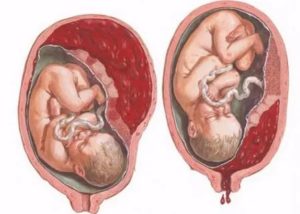 Может ли плацента опуститься