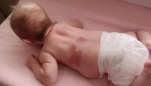 Пролежни у младенца