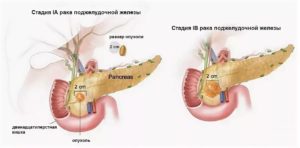 Рак пжж 4 стадия, прекратились боли что это значит?