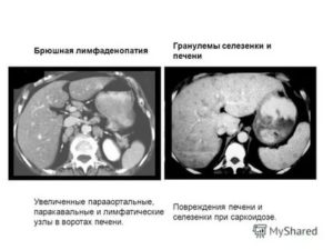 Увеличены лимфоузлы и селезенка