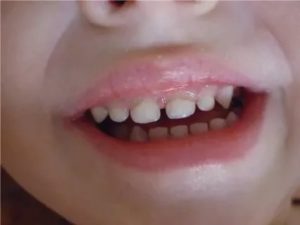 Темные полосы на передних зубах у ребенка
