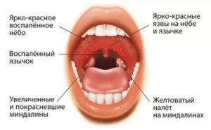 Может ли болеть язык по бокам при хроническом тонзиллофарингите