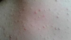 Сыпь на попе у ребенка