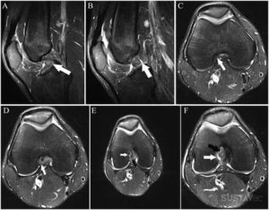 Расшифровка МРТ, показания к артроскопии