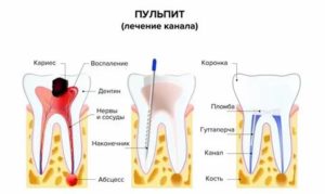 Острая зубная боль, открытый канал, антибиотики,