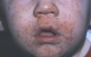 Использование пульмикорта и периоральный дерматит у ребенка
