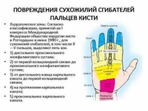 Травма сухожилия глубокого сгибателя, не разгибается палец