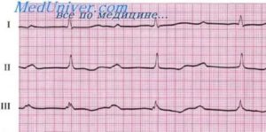 Ускоренная AV проводимость у беременных
