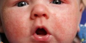 Аллергия на цветение у новорожденного
