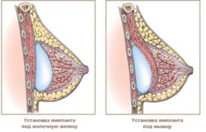 Резко уменьшилась грудь