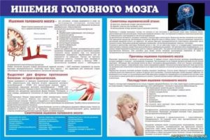 Ишемия головного мозга