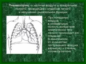 Пневмоторакс легкого, не выходит воздух