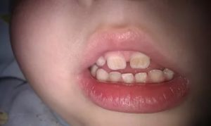 Темные полосы на передних зубах у ребенка