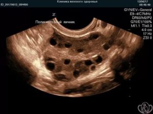 Стимуляция овуляции клостилбегитом и мультифолликулярные яичники