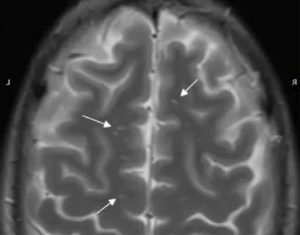 Нейройнфекция, очаги глиоза в лобной доли