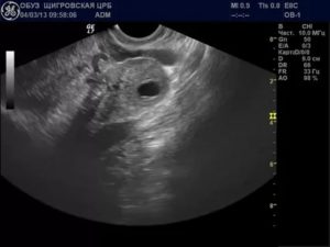Желтое тело в правом яичнике при беременности