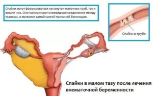 Беременность после удаления маточной трубы
