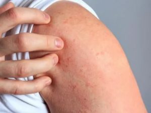 Аллергия на ципролет