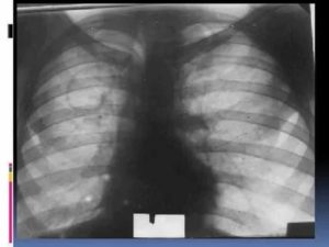 Результат флюорографии (спайки и диафрагма)