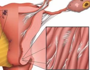 Боли при спайках и беременнсть