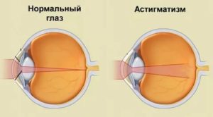 Астигматизм и спорт