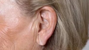 Складка на мочке уха