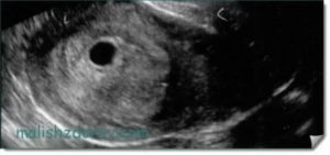 Анэмбриония на сроке 6 недель