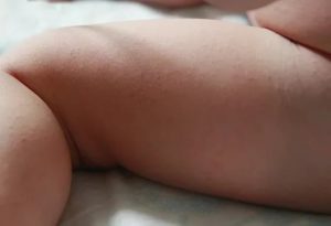 Сыпь у ребенка между ног