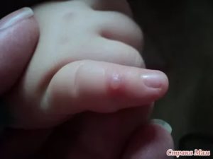 Твёрдый прыщ на пальце у ребёнка