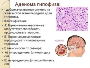 Аденома гипофиза лечение достинексом