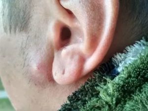 Шишка возле уха, при нажатии болит
