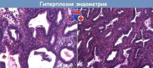 Рецидив очаговая базальная гиперплазия эндометрия, эндометриоз