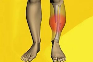 Онемение после перелома большой берцовой кости ноги