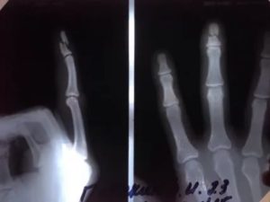 Перелом средней фаланги 4 пальца правой руки