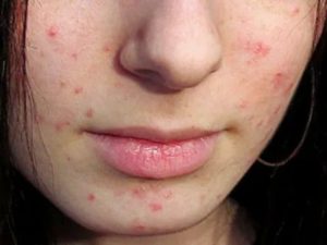 Сыпь на лице, или аллергия, или прыщи