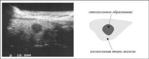 Гипоэхогенный узел с неровным контуром