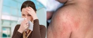 Аллергия на левомицетин