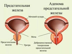 Спазмы в предстательной железе